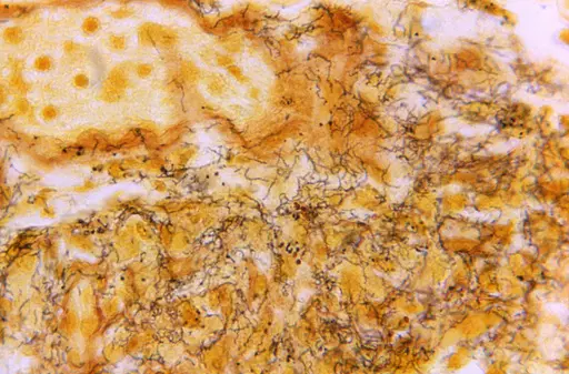 This 1966 microscope photo made available by the Centers for Disease Control and Prevention shows a tissue sample with the presence of numerous, corkscrew-shaped, darkly-stained, Treponema pallidum spirochetes, the bacterium responsible for causing syphilis. The U.S. syphilis epidemic continues to worsen, according to a new government report released Tuesday, Jan. 30, 2024, that also contains some unexpected good news — the rate of new gonorrhea cases has fallen for the first time in a decade.