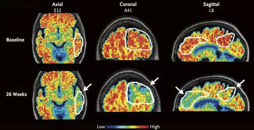 These PET scan images provided by the New England Journal of Medicine in January 2024 show a reduction in amyloid-beta levels in an Alzheimer's patient after focused ultrasound treatment to open the blood-brain barrier after 26 weeks. Red is associated with higher levels of amyloid-beta levels. Scientists have found a way to help Alzheimer’s drugs seep inside the brain faster _ by temporarily breaching its protective shield. (New England Journal of Medicine via AP)