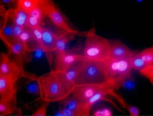 This undated fluorescence-colored microscope image made available by the National Institutes of Health in September 2016 shows a culture of human breast cancer cells. A study discussed at the 2022 meeting of the American Society of Clinical Oncology suggests some low-risk breast cancer patients can omit radiation after lumpectomy. (Ewa Krawczyk/National Cancer Institute via AP)