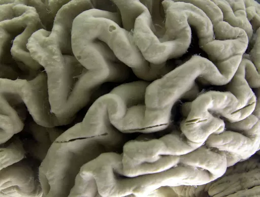 A closeup of a human brain affected by Alzheimer's disease, is displayed at the Museum of Neuroanatomy at the University at Buffalo in Buffalo, N.Y., on Oct. 7, 2003. According to findings published Wednesday, Feb. 21, 2024 in the New England Journal of Medicine, Alzheimer’s quietly ravages the brain long before symptoms appear and now scientists are getting a closer look at the domino-like sequence of those changes _ a potential window to one day intervene. (AP Photo/David Duprey)