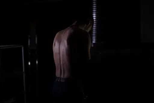 In this Nov. 23, 2022 photo, Igor shows the remains of marks on his back after allegedly being tortured by Russian forces in Kherson. The 22-year-old, accused of providing Ukrainians with Russia's military positions, was stung with a taser along his back for two and half hours and then forced to stay awake, seated in a chair all night. He was freed after two days but not before writing a letter providing details about a relative of his uncle's who the Russians wanted information on. (AP Photo/Be